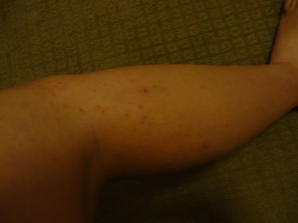 Leg Pimples