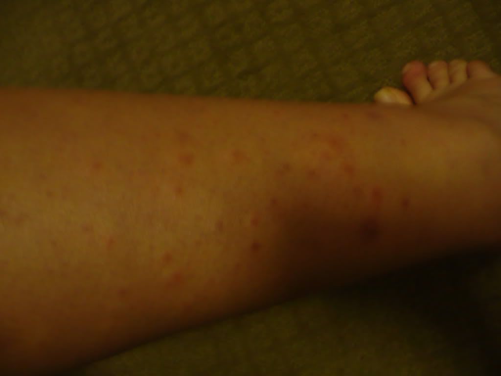 acne legs