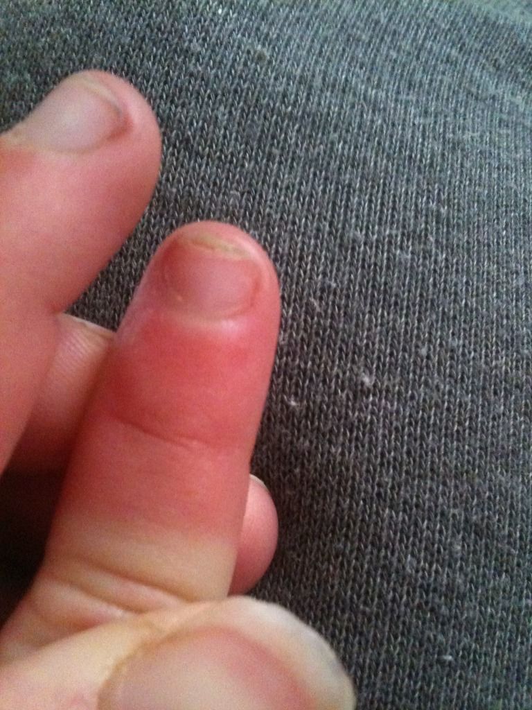 Peeling fingernails